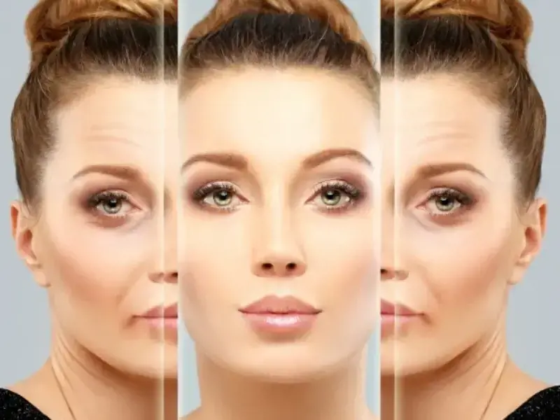 FALTENUNTERSPRITZUNG MIT HYALURONSÄURE