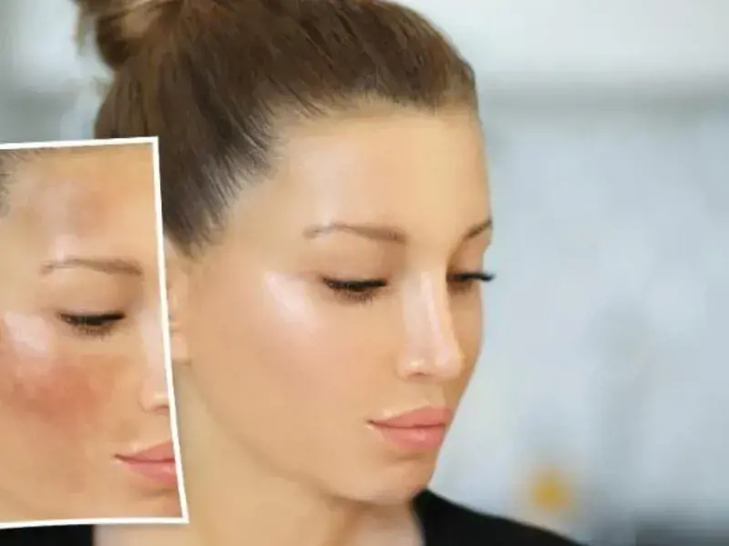 FRAKTIONIERTER CO2-LASER